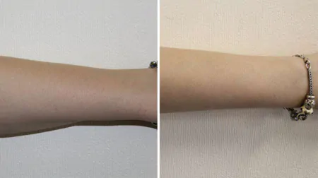 Фото до після: Руки до ліктів