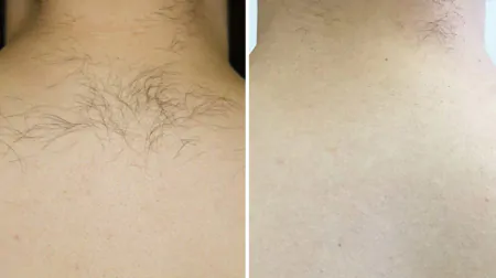 Фото до після: Верхня частина спини