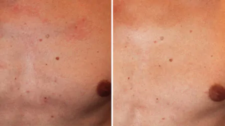 Фото до після: Груди