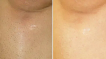 Фото до після: Гомілки та коліна