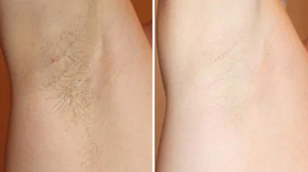 Фото до після: Під пахвами