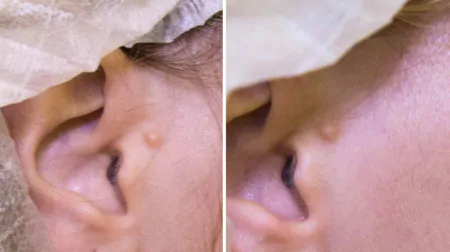 Фото до після: Скроні