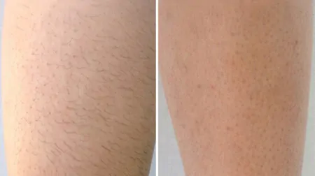 Фото до після: Ноги