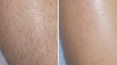 Фото до після: Ноги