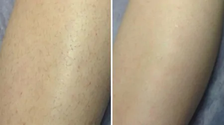 Фото до після: Ноги