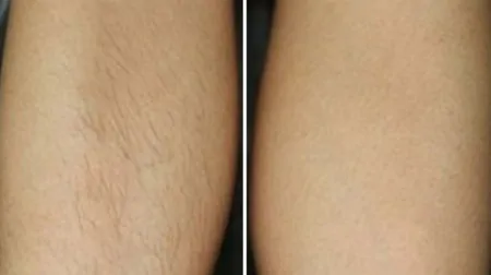 Фото до після: Ноги