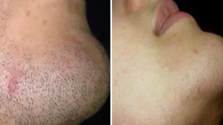 Фото до після: Підборіддя