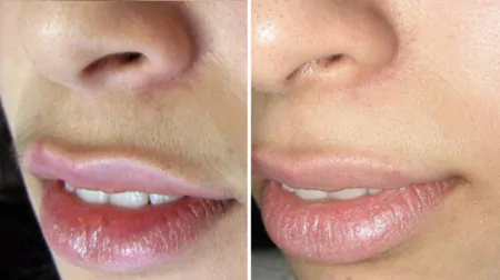 Фото до після: Над верхньою губою