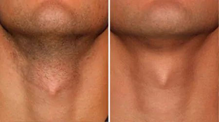 Фото до після: Борода і шия