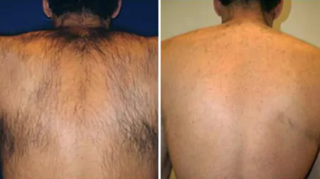 Фото до після: Спина