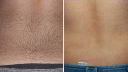 Фото до після: Спина