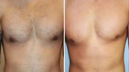 Фото до після: Груди та живіт