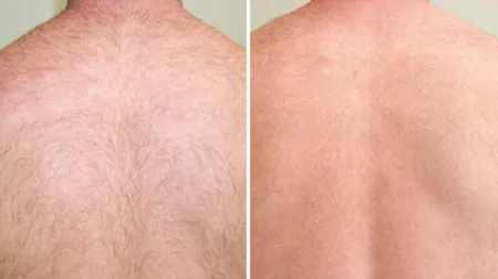 Фото до після: Спина