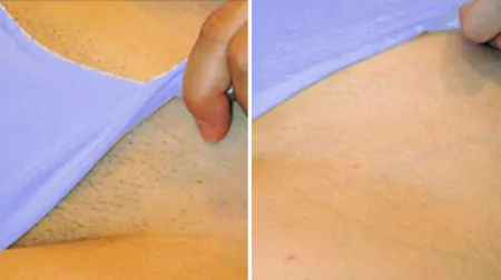 Фото до після: Бікіні частково (по лінії білизни)