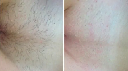 Фото до після: Глибоке бікіні