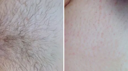 Фото до після: Глибоке бікіні