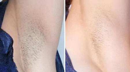 Фото до після: Під пахвами