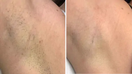 Фото до після: Під пахвами