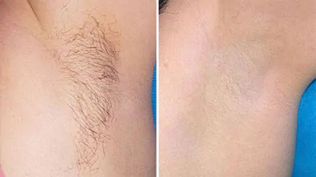 Фото до після: Під пахвами