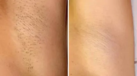 Фото до після: Під пахвами