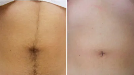 Фото до після: Біла лінія живота