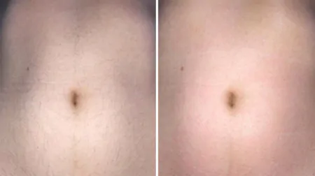 Фото до після: Живіт