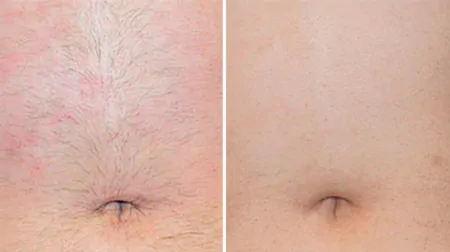 Фото до після: Живіт