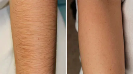 Фото до після: Руки до ліктів