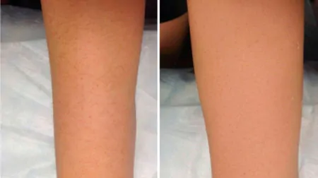 Фото до після: Руки повністю