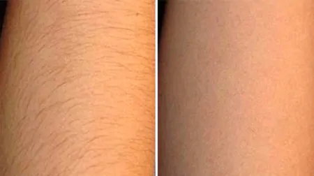 Фото до після: Руки до ліктів