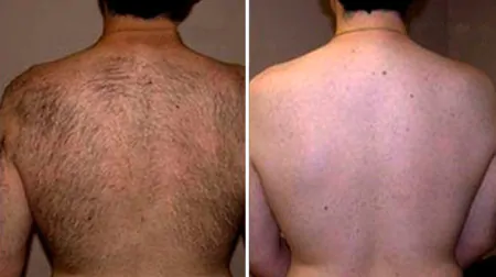 Фото до після: Спина