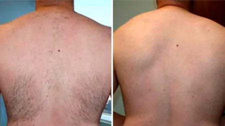 Фото до після: Спина