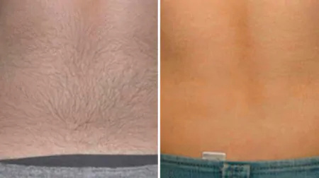 Фото до після: Спина