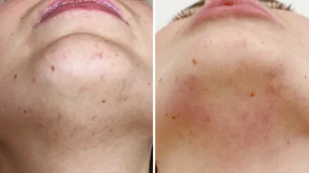 Фото до після: Підборіддя