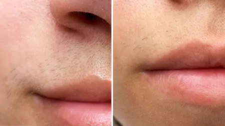 Фото до після: Верхня губа