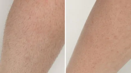 Фото до після: Ноги