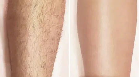 Фото до після: Ноги