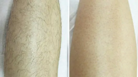 Фото до після: Ноги