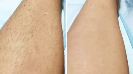 Фото до після: Ноги