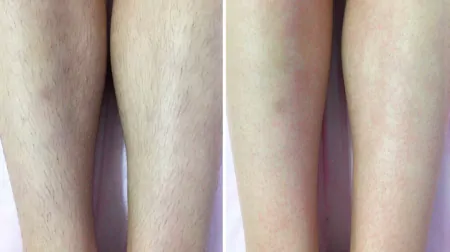 Фото до після: Ноги