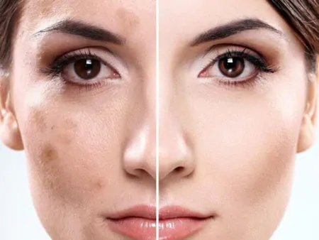 плями після лазерної епіляції фото