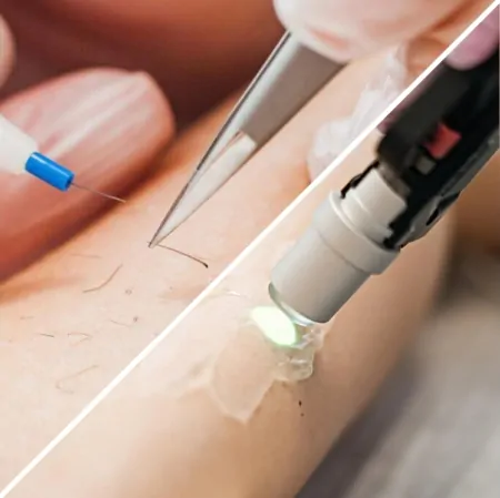 що краще лазерна чи електроепіляція