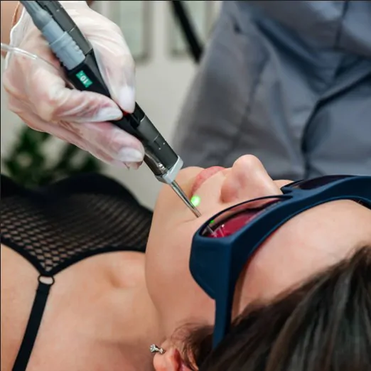 лазерна епіляція верхньої губи плюси і мінуси