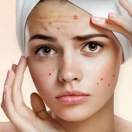 Чи можна робити лазерну епіляцію при акне?