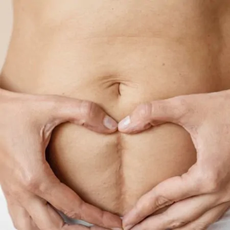 Чи можна робити лазерну епіляцію при келоїдних рубцях?